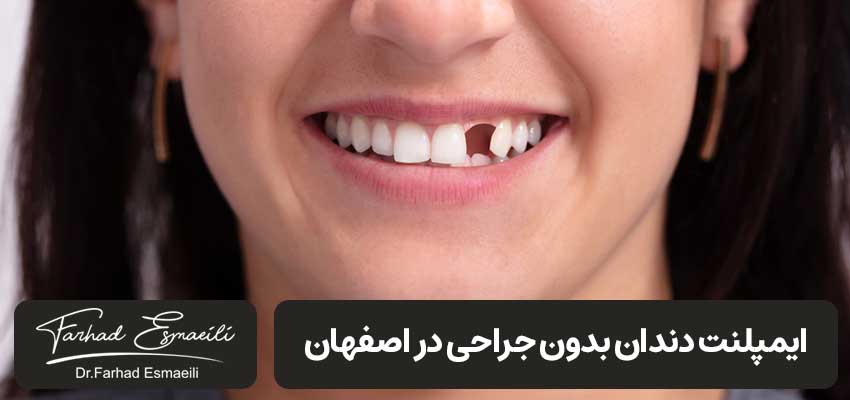 ایمپلنت دندان بدون جراحی در اصفهان