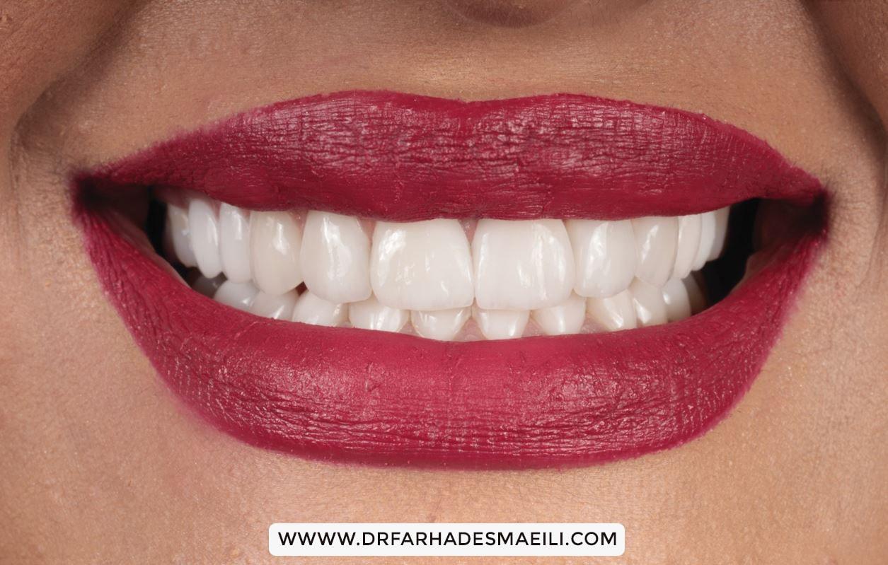 اصلاح طرح لبخند به روش دیجیتال توسط دکتر اسماعیلی