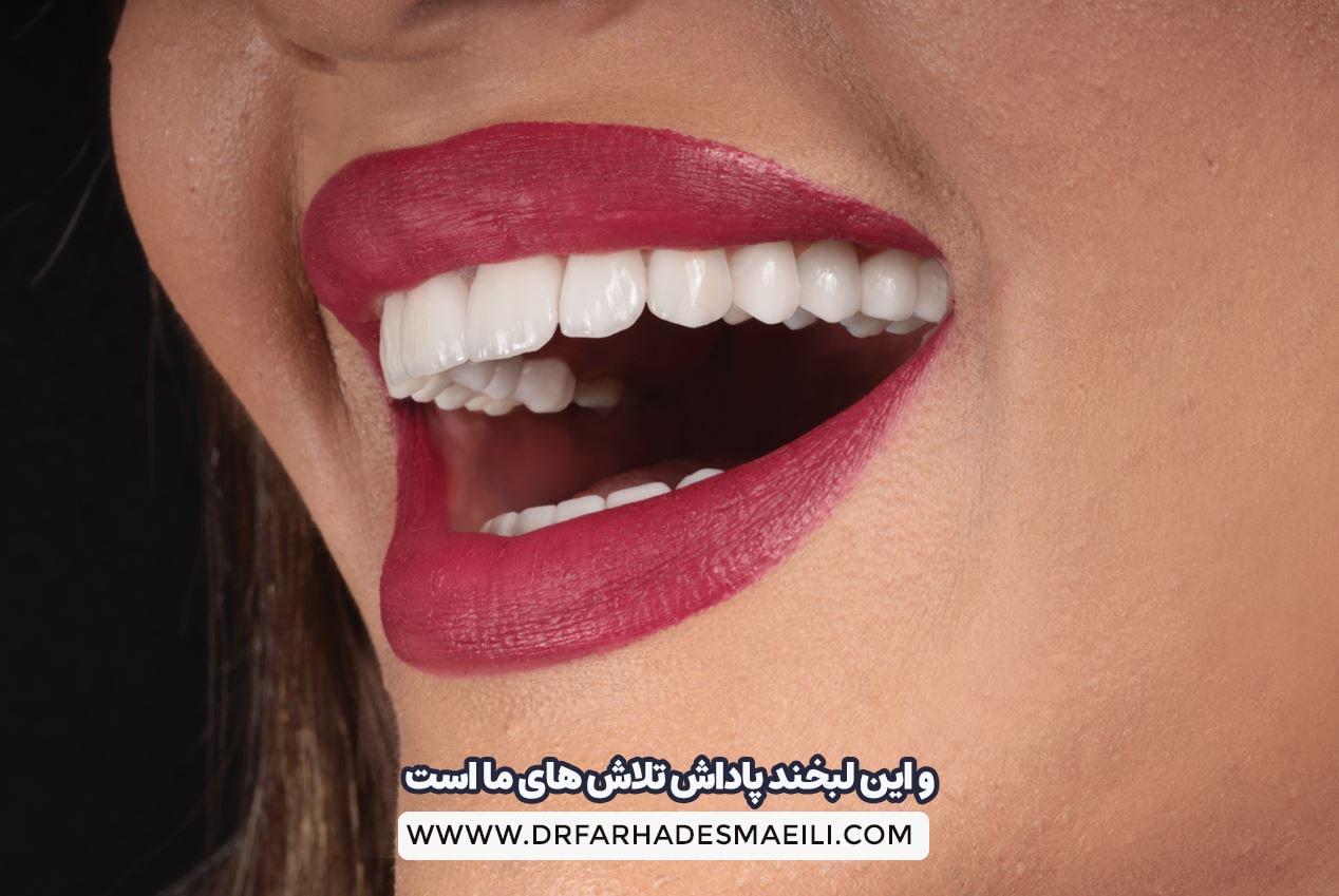 لبخند زیبا با اصلاح طرح لبخند همراه با ایمپلنت دیجیتال | دکتر اسماعیلی
