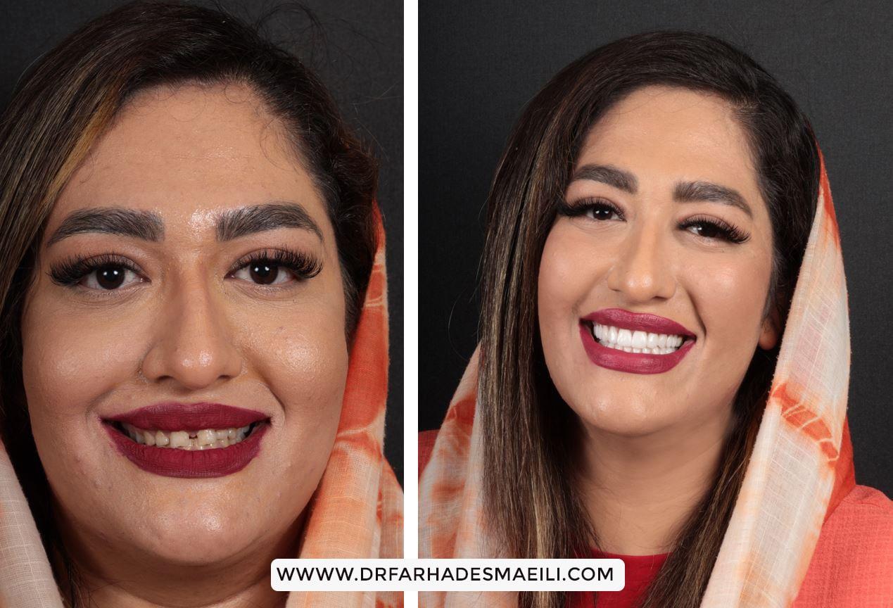 قبل و بعد از انجام اصلاح طرح لبخند | دکتر فرهاد اسماعیلی