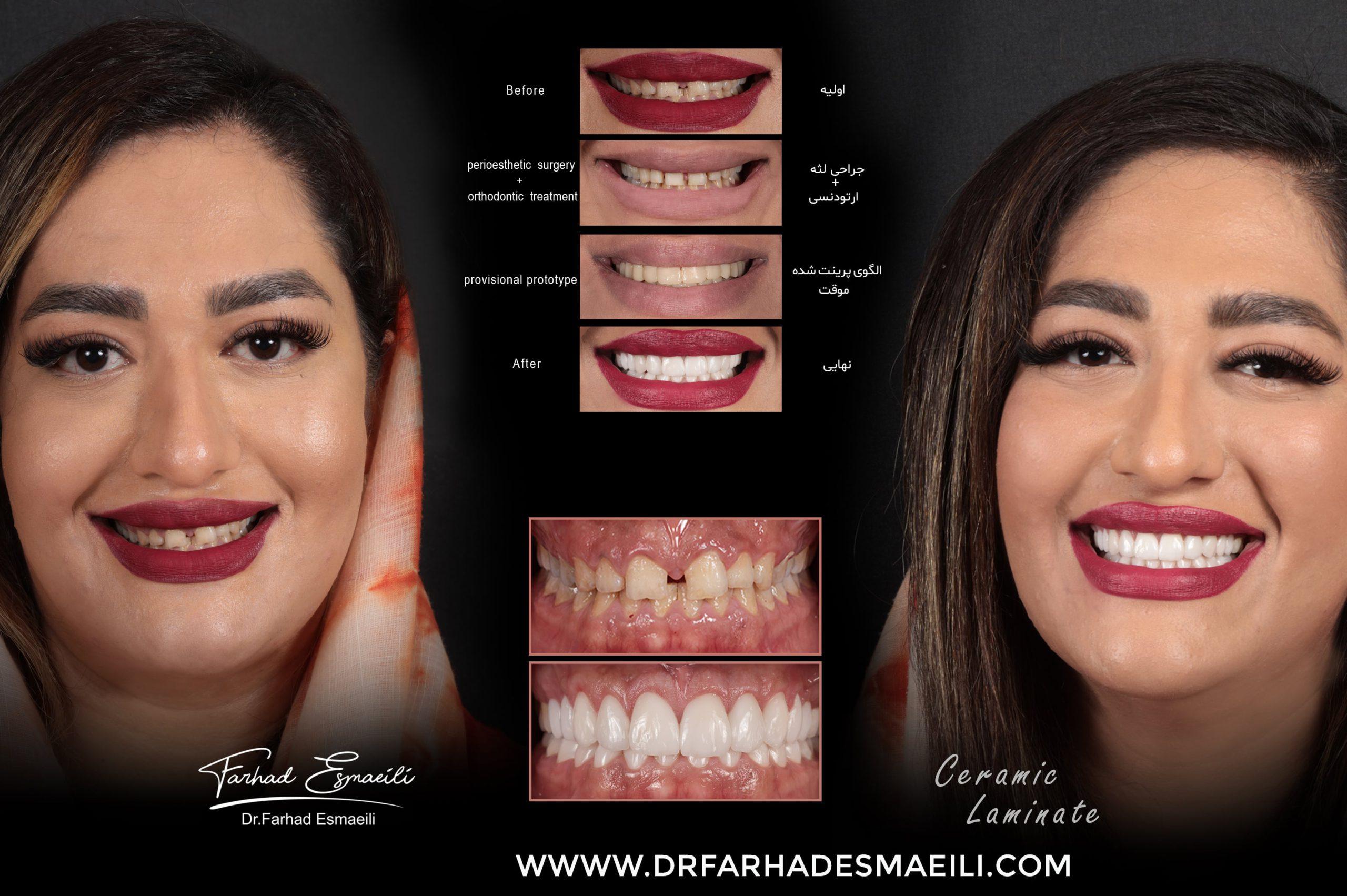 اصلاح طرح لبخند به روش دیجیتال | دکتر فرهاد اسماعیلی متخصص کاشت دندان در اصفهان