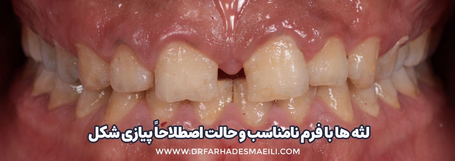 تصویر واضح از فرم نامناسب لثه ها و به اصلاح لثه پیازی شکل