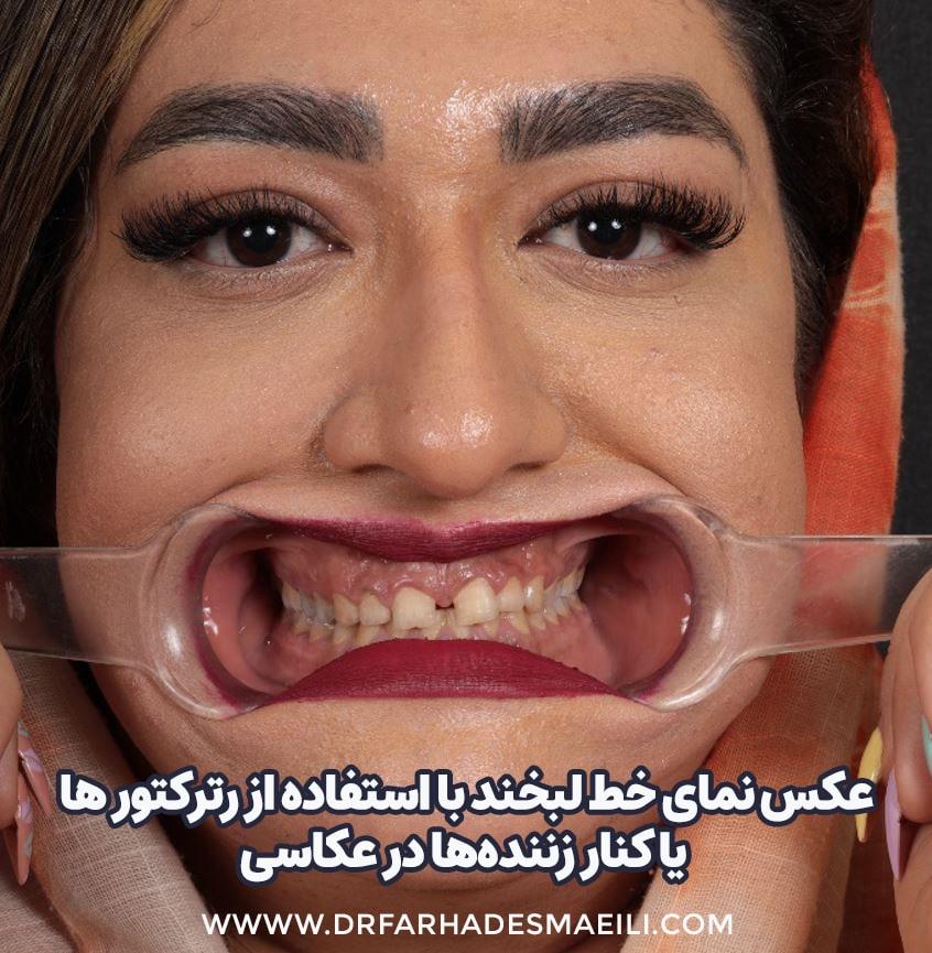 اصلاح طرح لبخند به روش دیجیتال و استفاده از پرینتر سه بعدی و اسکنر در اصفهان