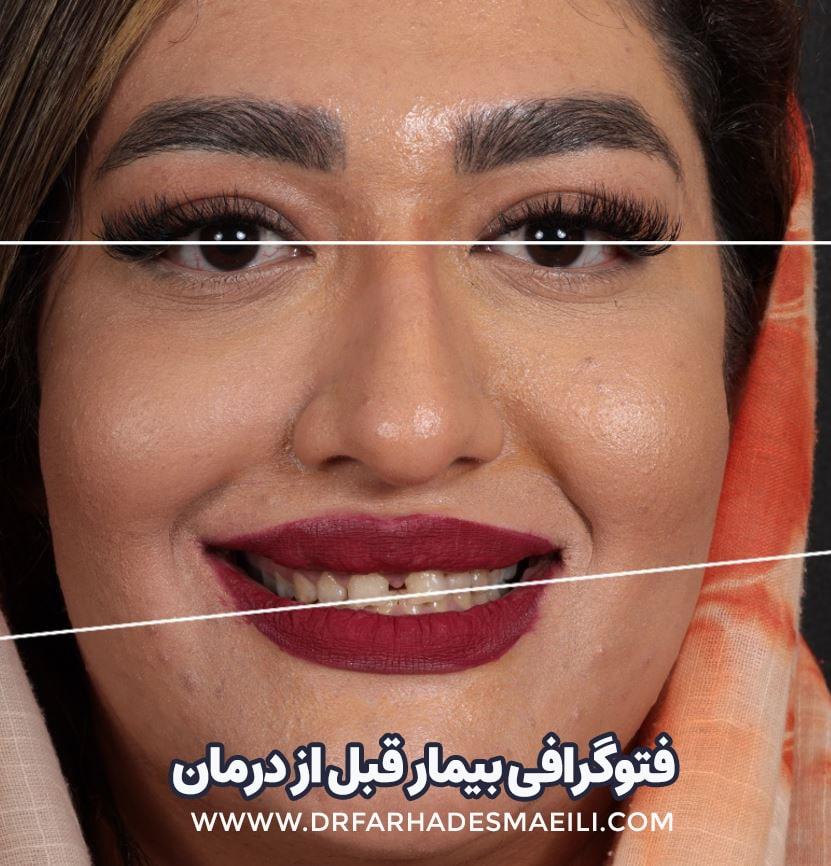 فتوگرافی بیمار قبل از درمان | دکتر فرهاد اسماعیلی متخصص کاشت دندان دیجیتال در اصفهان