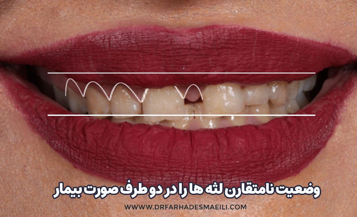 اصلاح طرح لبخند به روش دیجیتال و استفاده از پرینتر سه بعدی و اسکنر در اصفهان