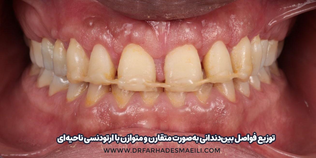 توزیع فواصل بین دندانی با ارتودنسی و متقارن کردن فاصله ی دندانی | دکتر فرهاد اسماعیلی