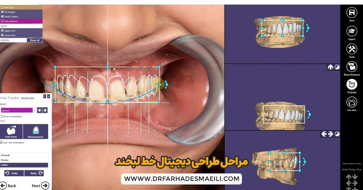 مراحل طراحی دیجیتال خط لبخند | دکتر اسماعسلی متخصص ایملنت در اصفهان