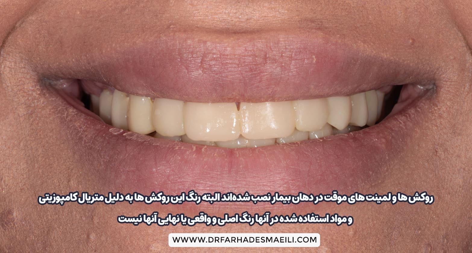 روکش و لمینت موقت برای ایمپلنت دیجیتال | دکتر فرهاد اسماعیلی