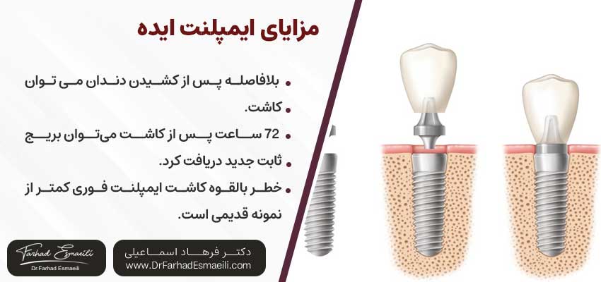 مزایای ایمپلنت ایده یکی از انواع ایمپلنت سوئیسی | دکتر فرهاد اسماعیلی متخصص ایمپلنت اصفهان