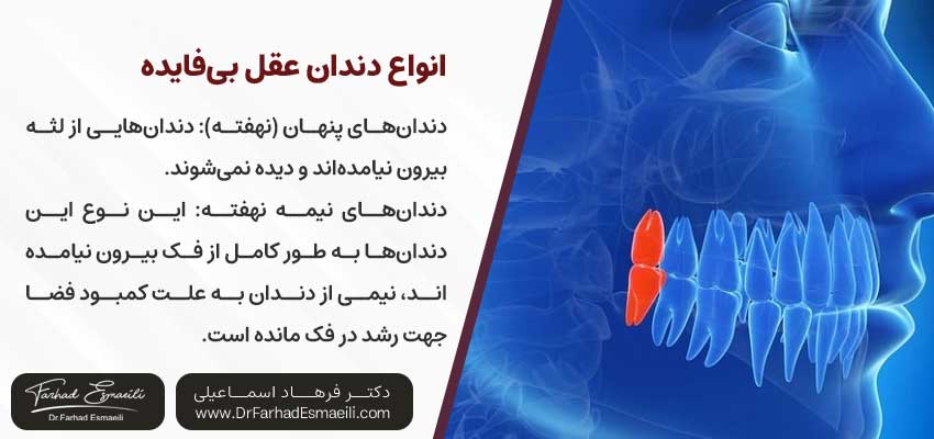 انواع دندان عقل بی‌فایده | دکتر فرهاد اسماعیلی متخصص ایمپلنت در اصفهان