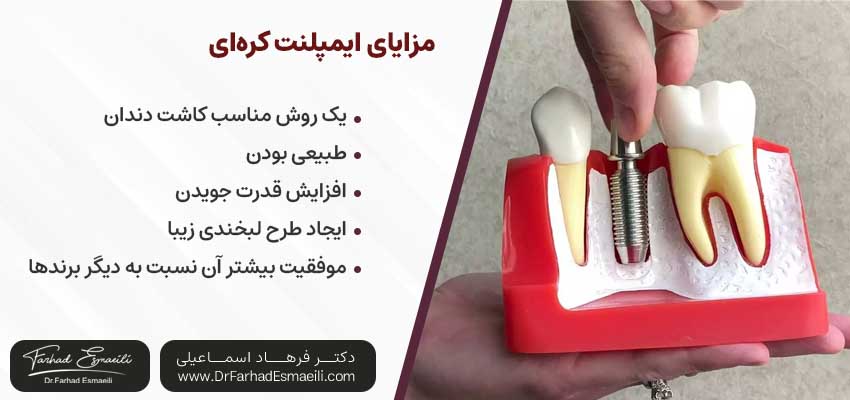 مزایای ایمپلنت کرهای| دکتر فرهاد اسماعیلی متخصص ایمپلنت اصفهان