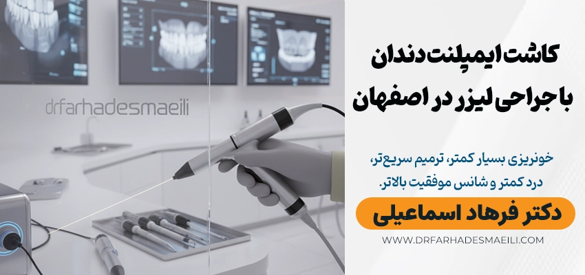 ایمپلنت لیزری در اصفهان؛ نسل جدید کاشت دندان با دقت میکرونی و ترمیم سریعتر با دکتر فرهاد اسماعیلی