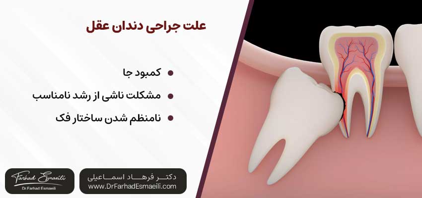 علت جراحی دندان عقل | دکتر فرهاد اسماعیلی متخصص ایمپلنت در اصفهان