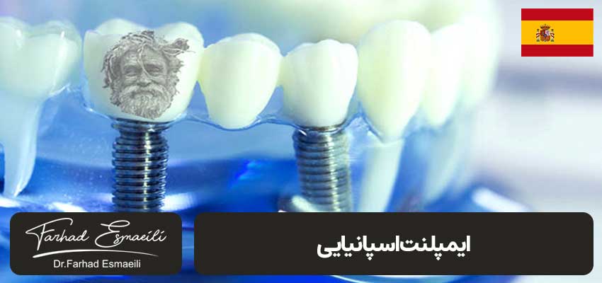 ایمپلنت اسپانیایی | دکتر فرهاد اسماعیلی متخصص ایمپلنت اصفهان