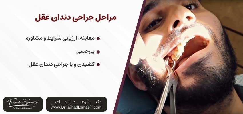 مراحل جراحی دندان عقل | دکتر فرهاد اسماعیلی متخصص ایمپلنت در اصفهان