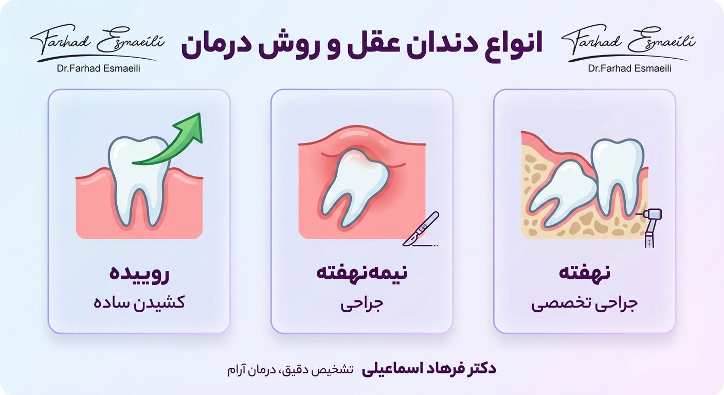 چه نوع دندان عقلهایی نیاز به جراحی دارند؟
