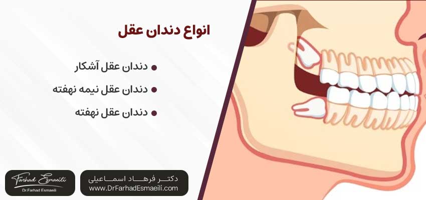 انواع دندان عقل | دکتر فرهاد اسماعیلی متخصص ایمپلنت در اصفهان