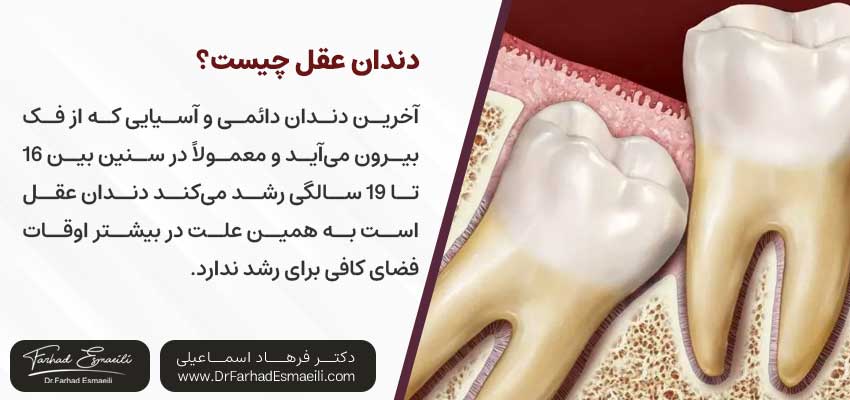 دندان عقل چیست؟ | دکتر فرهاد اسماعیلی متخصص ایمپلنت در اصفهان