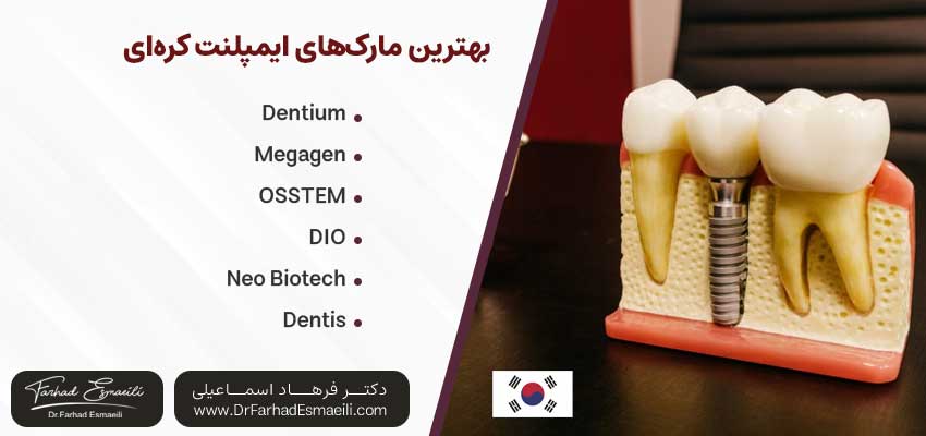 ایمپلنت کره‌ ای در اصفهان(بهترین برندها) - دکتر فرهاد اسماعیلی