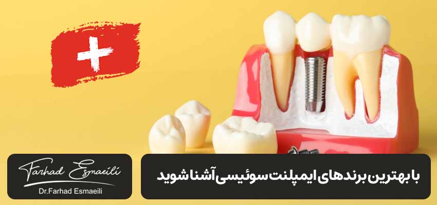 بهترین ایمپلنت سوئیسی | دکتر فرهاد اسماعیلی متخصص ایمپلنت اصفهان