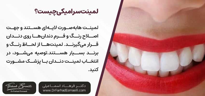 لمینت سرامیکی چیست؟ | دکتر فرهاد اسماعیلی متخصص ایمپلنت در اصفهان