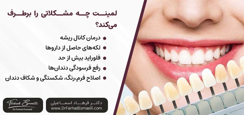 انواع لمینت دندان چه مشکلاتی را برطرف می‌کنند؟ | دکتر فرهاد اسماعیلی متخصص ایمپلنت در اصفهان
