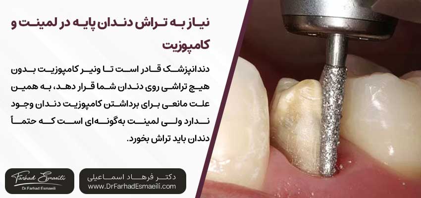 نیاز به تراش دندان پایه در لمینت و کامپوزیت | دکتر فرهاد اسماعیلی متخصص ایمپلنت در اصفهان