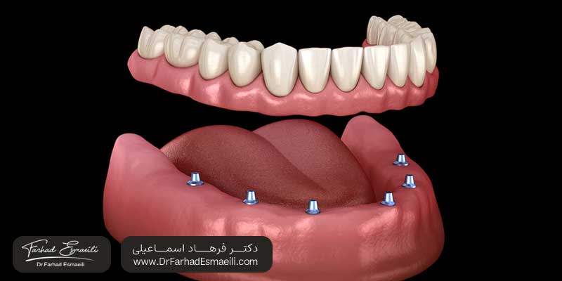 انواع اوردنچر | دکتر فرهاد اسماعیلی متخصص ایمپلنت در اصفهان