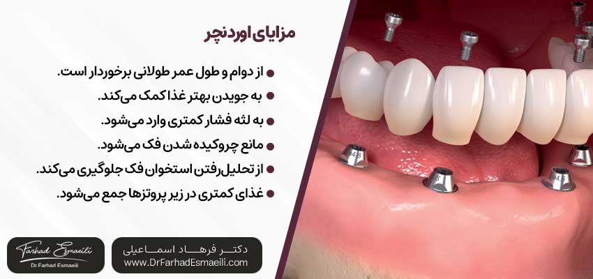 مزایای اوردنچر | دکتر فرهاد اسماعیلی متخصص ایمپلنت در اصفهان
