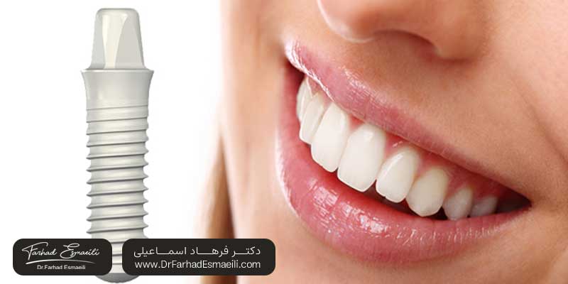 مقایسه ایمپلنتهای تیتانیومی و زیرکونیومی | دکتر فرهاد اسماعیلی متخصص ایمپلنت در اصفهان