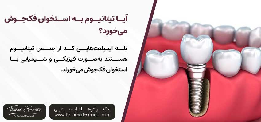 آیا تیتانیوم به استخوان فکجوش میخورد؟ | دکتر فرهاد اسماعیلی متخصص ایمپلنت در اصفهان