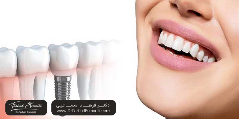 ایمپلنتهای تیتانیومی چند سال در بدن انسان دوام میآورند؟ | دکتر فرهاد اسماعیلی متخصص ایمپلنت در اصفهان