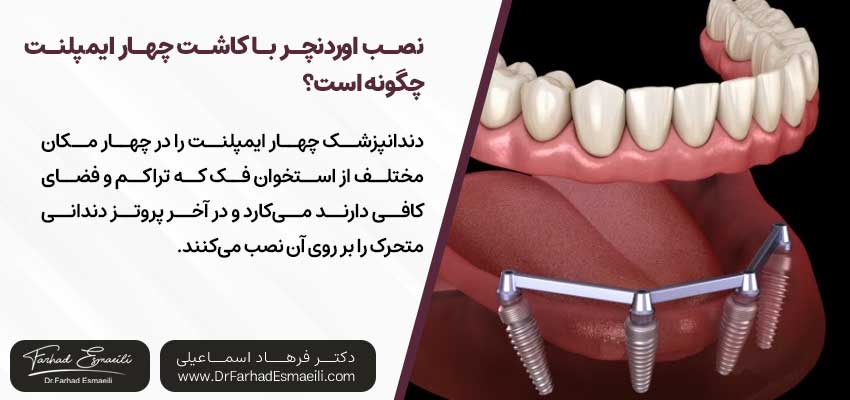 نصب اوردنچر با کاشت چهار ایمپلنت چگونه است؟ | دکتر فرهاد اسماعیلی متخصص ایمپلنت در اصفهان