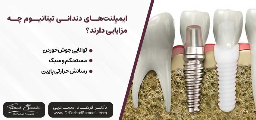ایمپلنت‌های دندانی تیتانیوم چه مزایایی دارند؟ | دکتر فرهاد اسماعیلی متخصص ایمپلنت در اصفهان 