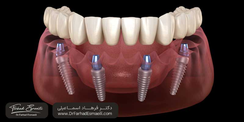 اوردنچر چیست ؟ | دکتر فرهاد اسماعیلی متخصص ایمپلنت در اصفهان