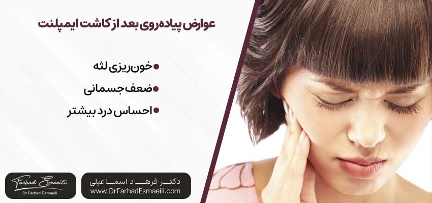 عوارض ورزش بعد از کاشت ایمپلنت | دکتر فرهاد اسماعیلی متخصص ایمپلنت در اصفهان
