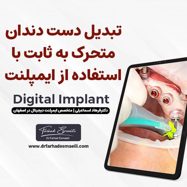 تبدیل دست دندان متحرک به ثابت با ایمپلنت دیجیتال
