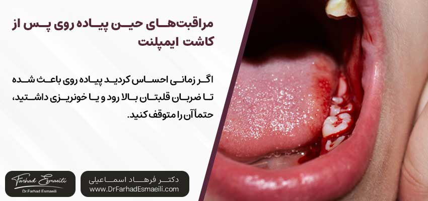 مراقبت‌های حین ورزش پس از کاشت ایمپلنت | دکتر فرهاد اسماعیلی متخصص ایمپلنت در اصفهان