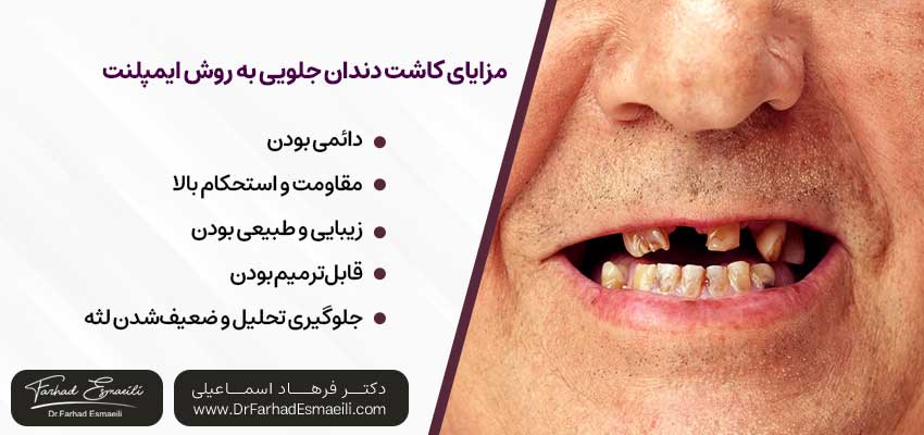 مزایای کاشت دندان جلویی به روش ایمپلنت