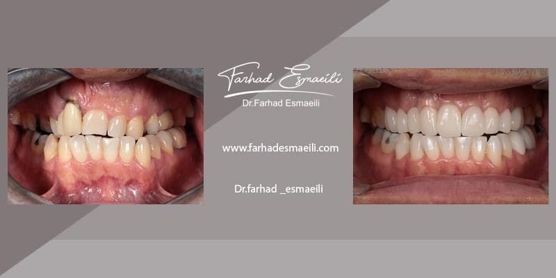 طراحی دیجیتال خط لبخند برای بیمار با مشکل شکاف کام و لب