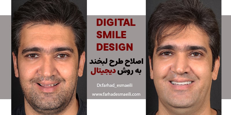 اصلاج طرح لبخند به روش دیجیتال با مشکلات شکاف کام و لب