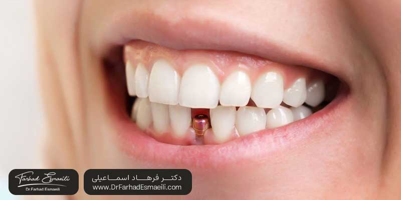 هزینه کاشت دندان جلویی