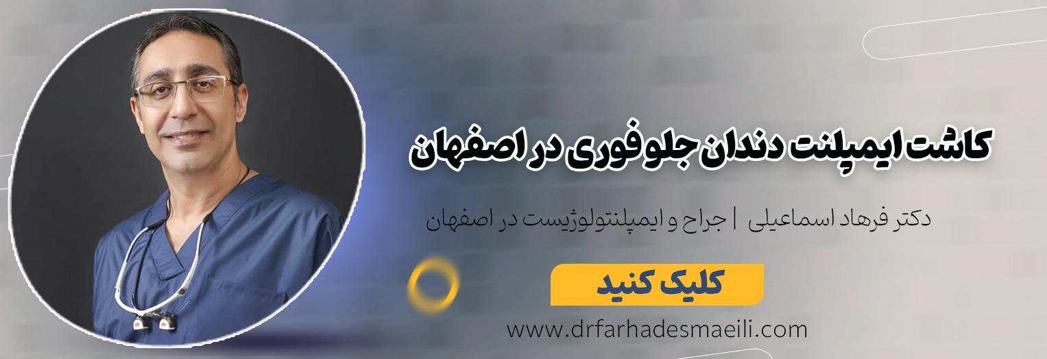 کاشت ایمپلنت دندان جلو در اصفهان