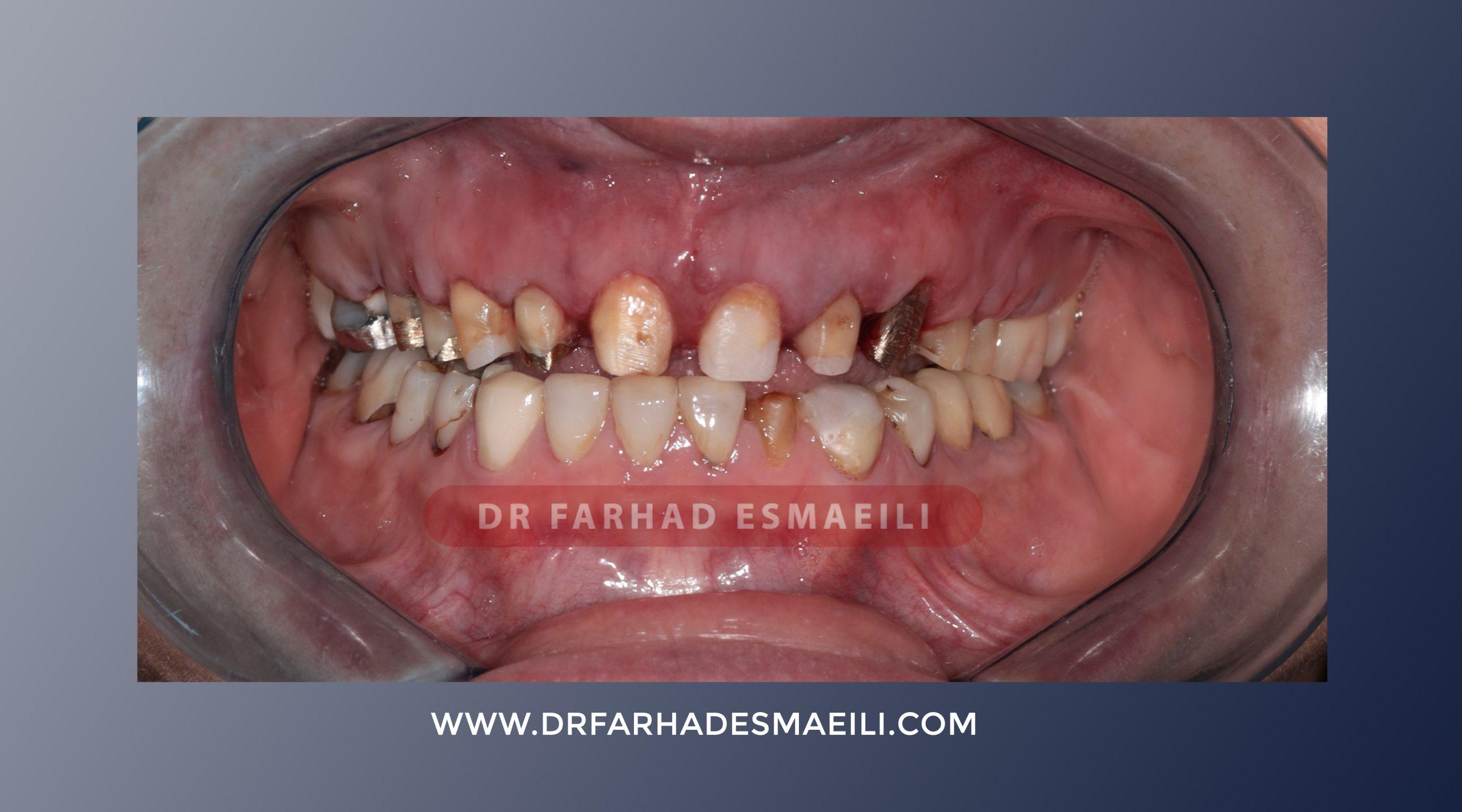 طراحی لبخند با طراحی دیجیتال در اصفهان