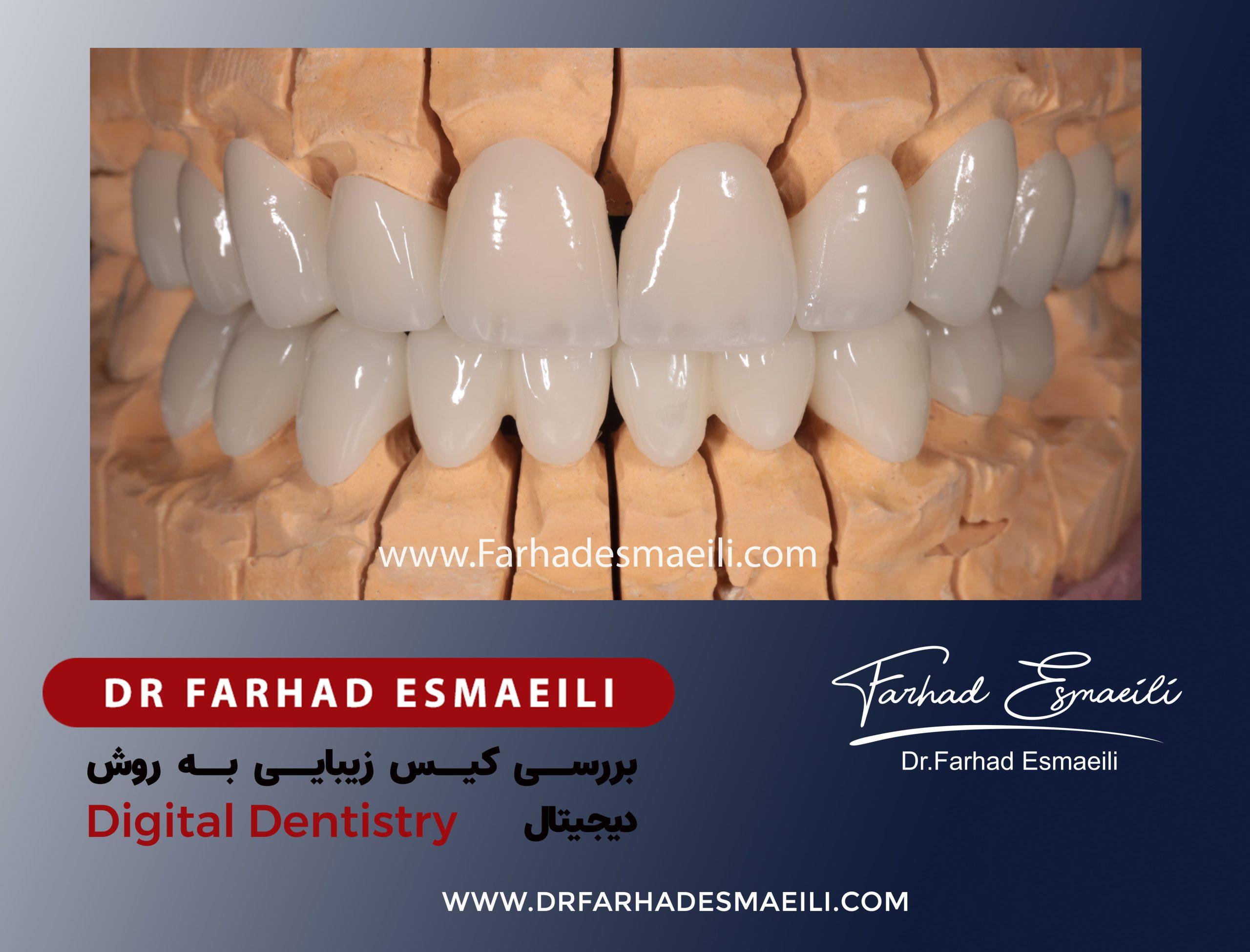 طراحی لبخند نامتقارن با طراحی دیجیتال در اصفهان