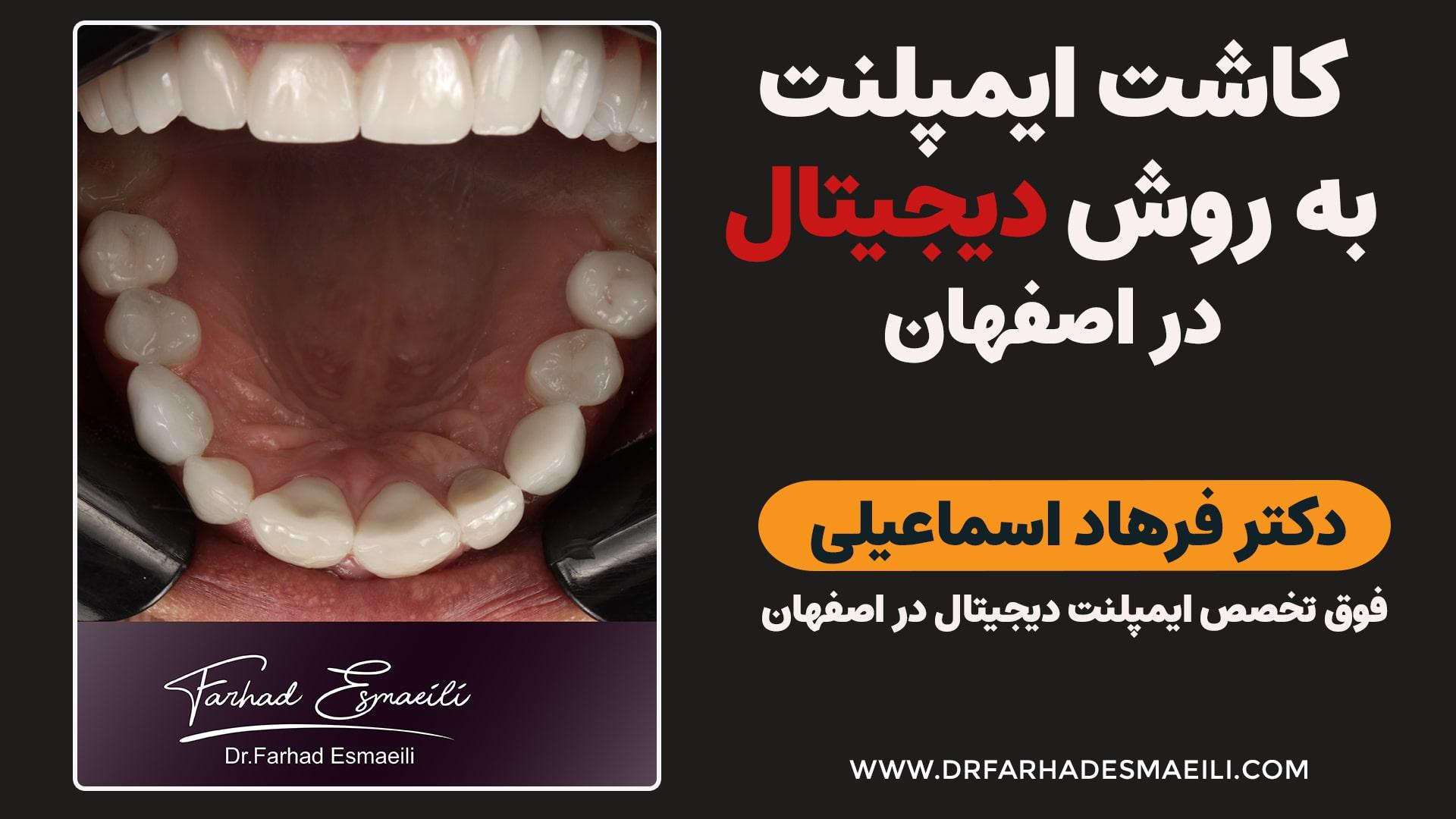 درمان شکستگی کامل تاج با کاشت ایمپلنت دیجیتال در اصفهان