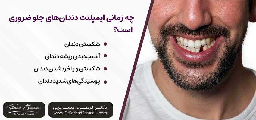 چه زمانی ایمپلنت دندان‌های جلو ضروری است؟