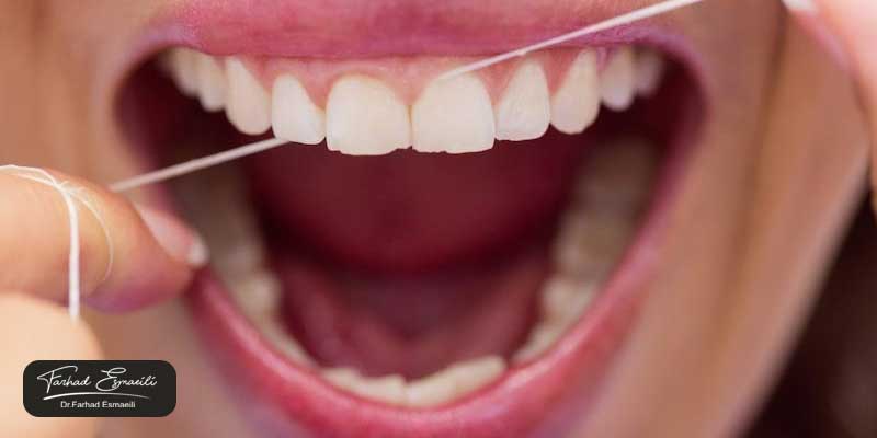 آیا می‌توان لمینت را جایگزین کامپوزیت کرد؟