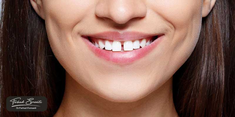 حذف کامپوزیت با دریل های کاربیدی