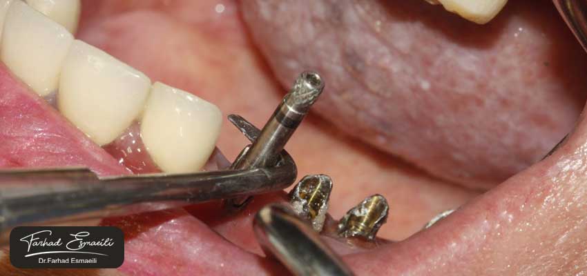 آیا دندان قروچه باعث افزایش خطر شکست ایمپلنت می‌شود؟
